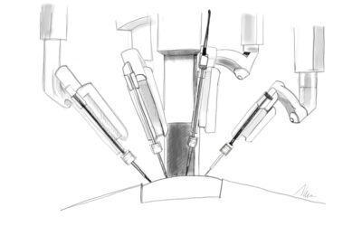 La prostatectomía robótica Da Vinci