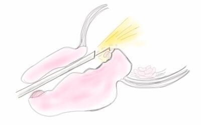 Hipertrofia benigna de próstata