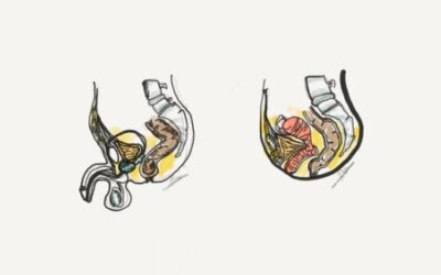 Las infecciones de orina de repetición